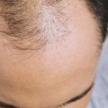 Can Too Much Vitamin and Nutritional Supplement Cause Hair Loss?