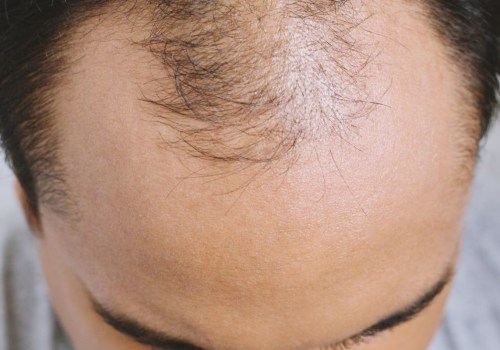 Can Too Much Vitamin and Nutritional Supplement Cause Hair Loss?